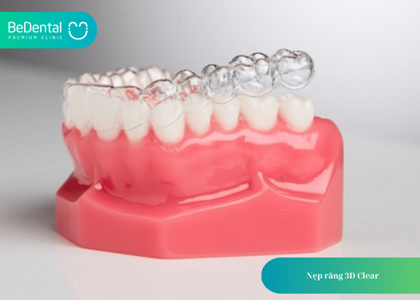 Nẹp răng nhựa và 4 điều cần biết 5 How much does teeth whitening cost 6 min 5