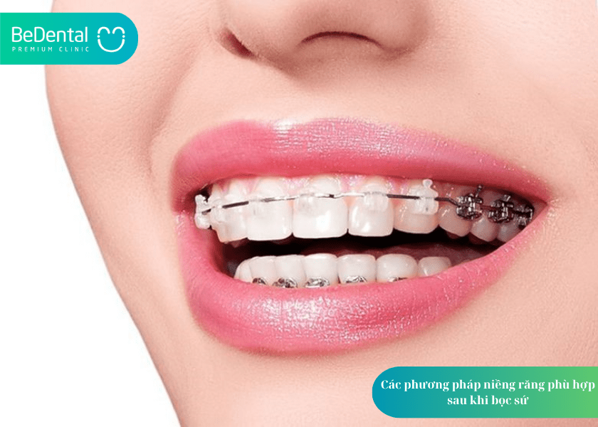 Răng sứ có niềng được không? Giải đáp chi tiết từ chuyên gia nha khoa 6 How much does teeth whitening cost 6 min 6