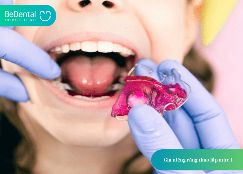 Niềng Răng Tháo Lắp Mức 1: Phương Pháp Chỉnh Nha Sớm Hiệu Quả Cho Trẻ Em 3 How much does teeth whitening cost 6 min 7