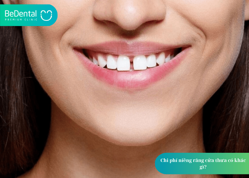 Niềng răng thưa 1 hàm giá bao nhiêu? Bảng giá chi tiết và lưu ý quan trọng 6 How much does teeth whitening cost 6 min 8