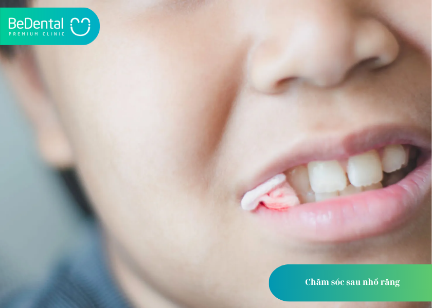 Răng Khôn Mọc Lệch Ra Má Hàm Trên: Tác Hại Và Cách Xử Lý 7 How much does teeth whitening cost 7 3