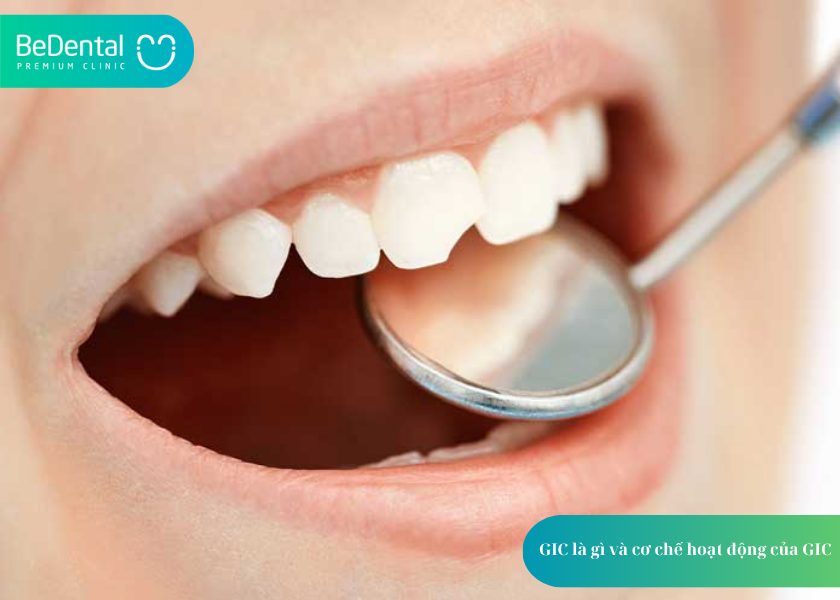 GIC là gì? 1 trong 3 vật liệu trám răng phổ biến trong nha khoa 2 GIC là gì?