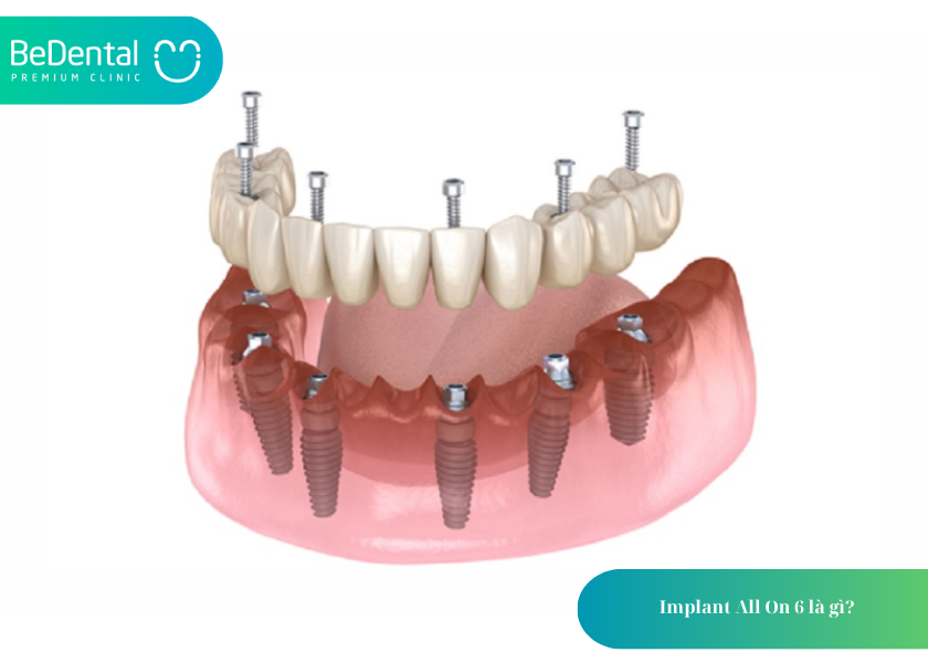 Trồng răng Implant All on 6: Giải pháp phục hình toàn hàm tối ưu cho người mất răng 2 How much does teeth whitening cost 7 5