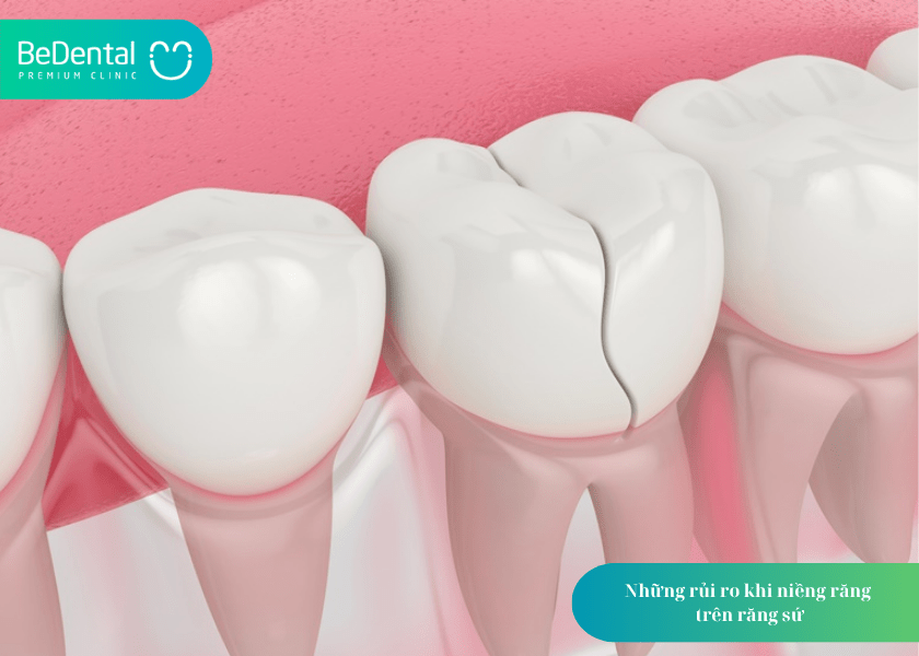 Răng sứ có niềng được không? Giải đáp chi tiết từ chuyên gia nha khoa 7 How much does teeth whitening cost 7 min 5