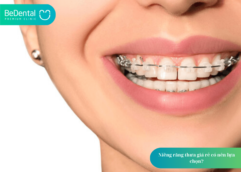 Niềng răng thưa 1 hàm giá bao nhiêu? Bảng giá chi tiết và lưu ý quan trọng 7 How much does teeth whitening cost 7 min 7