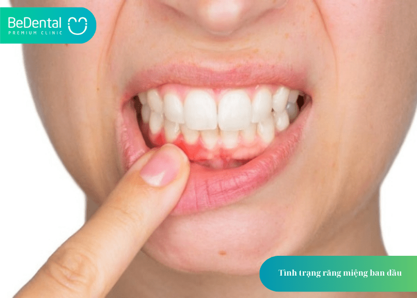 Niềng răng thưa mất bao lâu? Thời gian và 4 điều cần biết 7 How much does teeth whitening cost 7 min 8