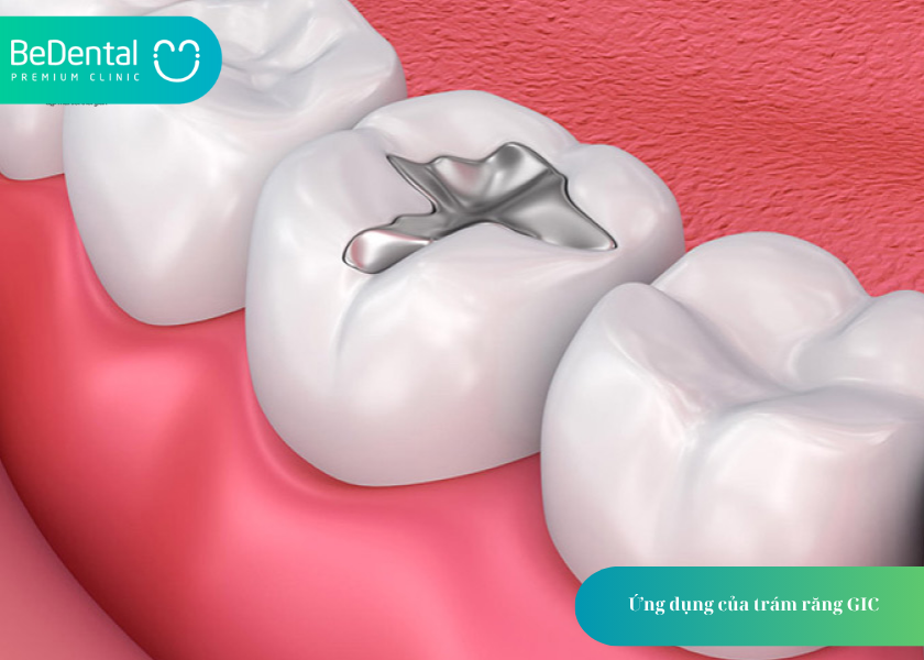 GIC là gì? 1 trong 3 vật liệu trám răng phổ biến trong nha khoa 3 How much does teeth whitening cost 8 3
