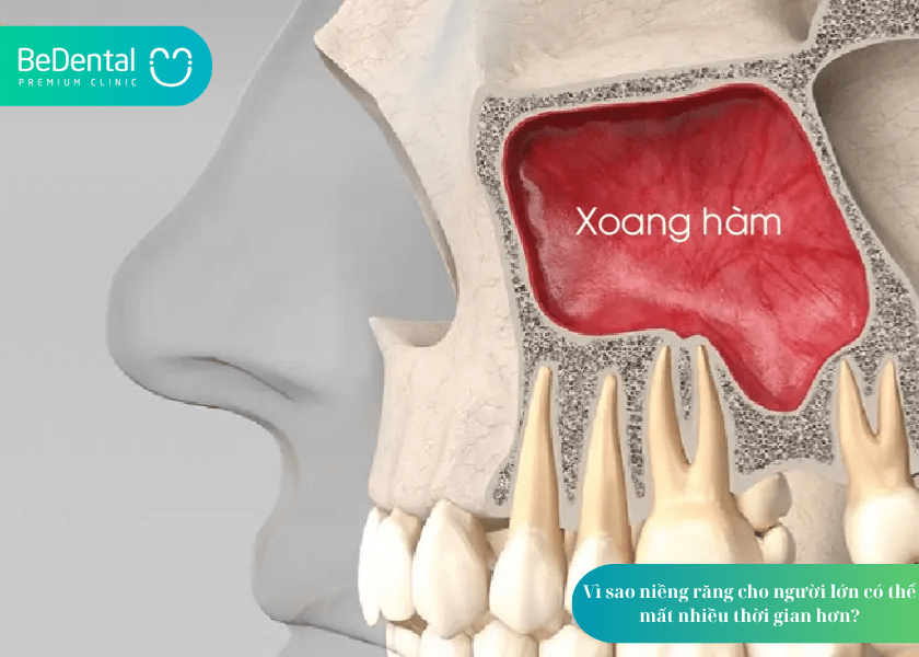 Niềng răng cho người lớn mất bao lâu? Giải đáp chi tiết từ chuyên gia 4 How much does teeth whitening cost 8 min 1