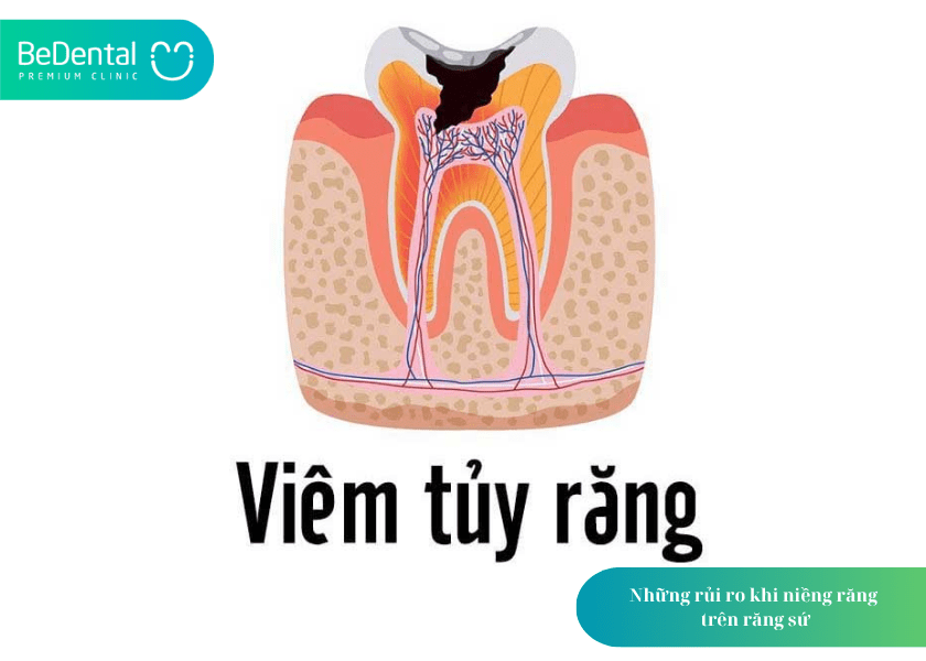 Răng sứ có niềng được không? Giải đáp chi tiết từ chuyên gia nha khoa 8 How much does teeth whitening cost 8 min 4
