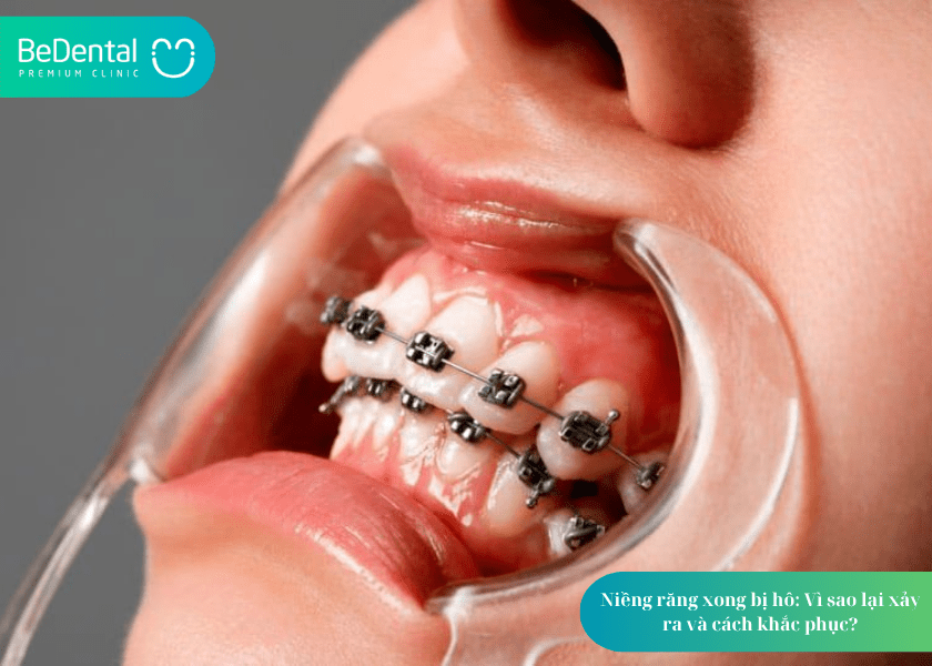 How much does teeth whitening cost 8 min 6