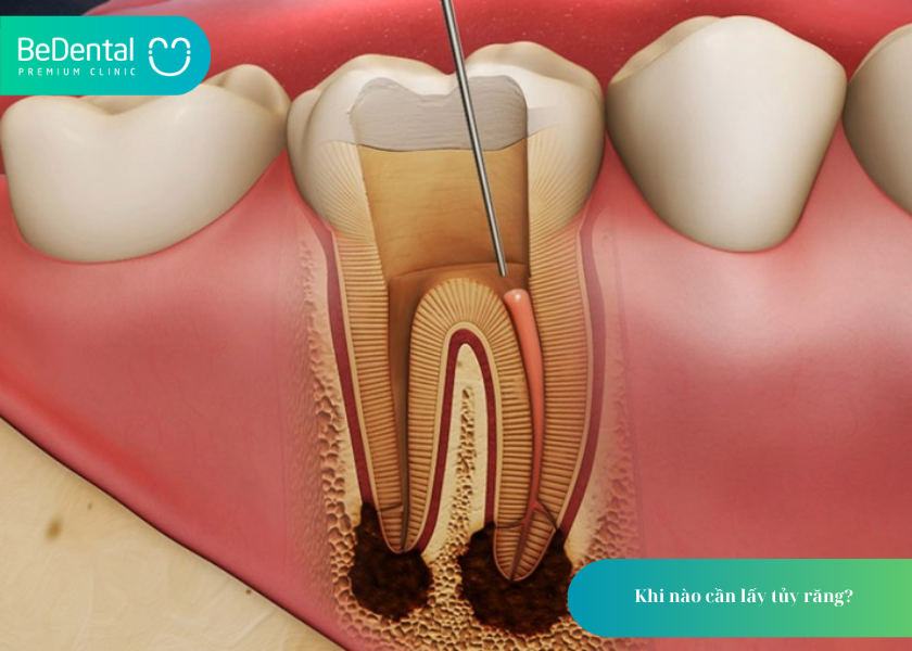 Quy trình lấy tủy răng: Giải pháp bảo tồn răng thật an toàn, hiệu quả 2 How much does teeth whitening cost 9 1