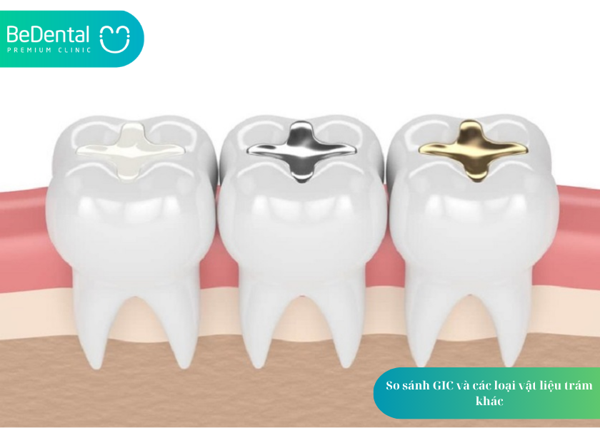GIC là gì? 1 trong 3 vật liệu trám răng phổ biến trong nha khoa 4 How much does teeth whitening cost 9 3