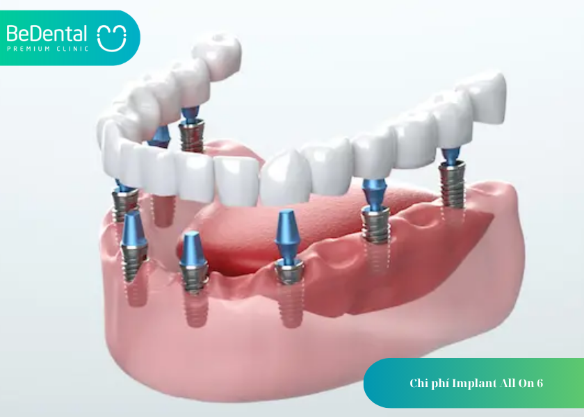 Trồng răng Implant All on 6: Giải pháp phục hình toàn hàm tối ưu cho người mất răng 3 How much does teeth whitening cost 9 4