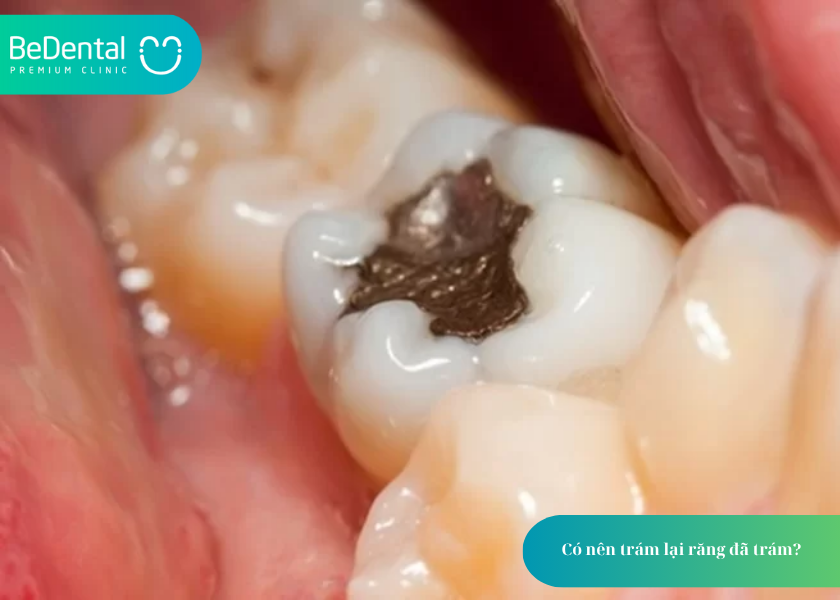 How much does teeth whitening cost 9 5