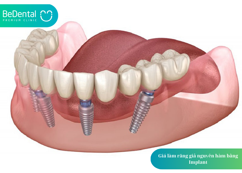 GIÁ LÀM RĂNG GIẢ NGUYÊN HÀM: 3 THÔNG TIN CHI TIẾT CHO NGƯỜI MẤT RĂNG TOÀN HÀM 3 How much does teeth whitening cost 9 6