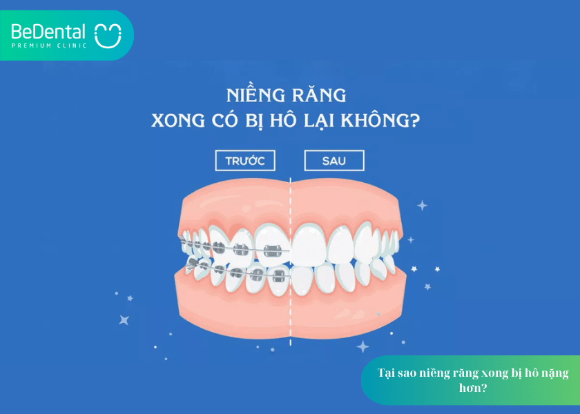 Niềng răng xong bị hô: Vì sao lại xảy ra và cách khắc phục? 2 Niềng răng xong bị hô