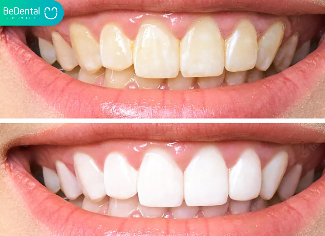 Tác hại của tẩy trắng răng 5 Tác hại của tẩy trắng răng