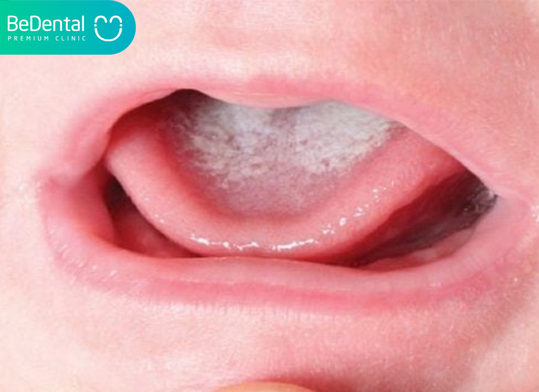 thuốc trị nấm miệng