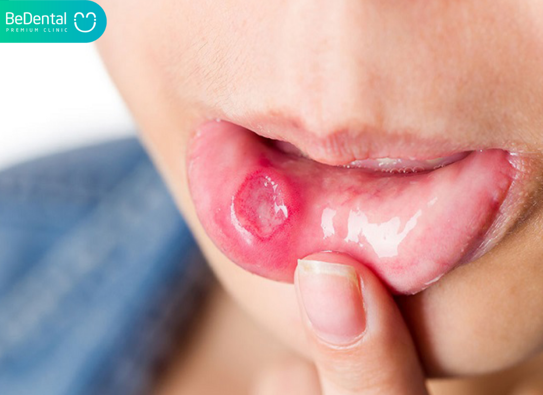 trẻ bị nhiệt miệng nên ăn gì