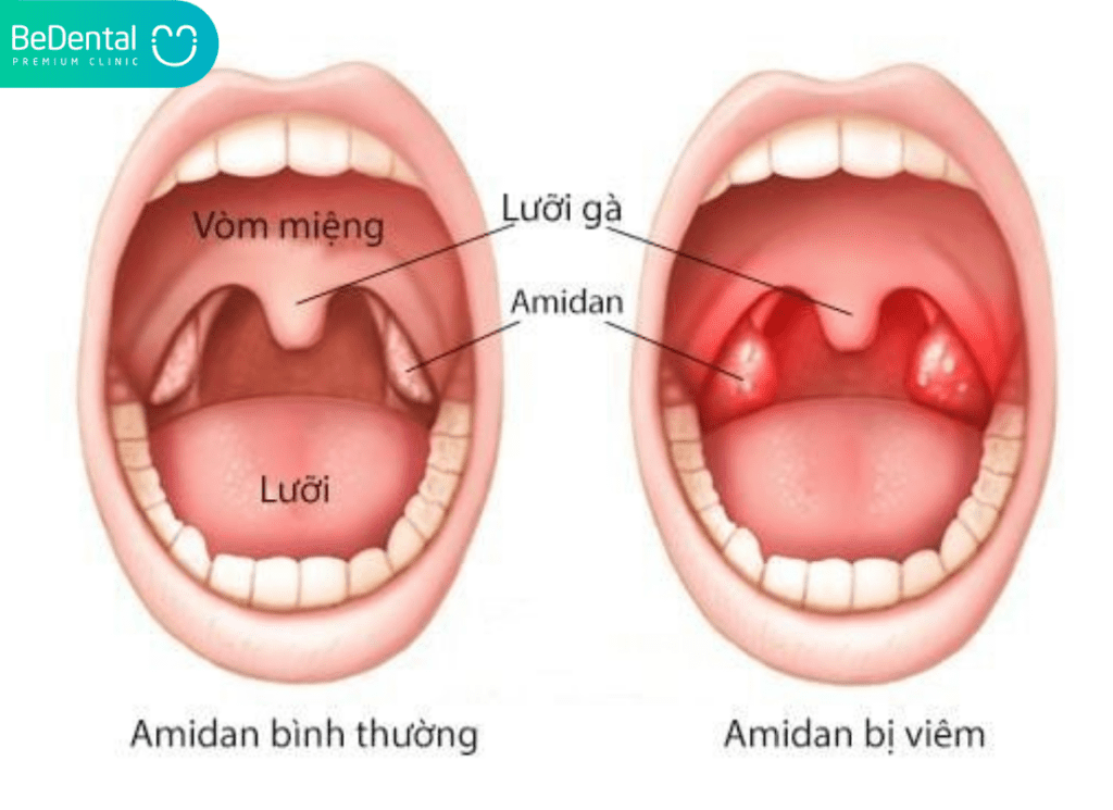 Trẻ Bị Hôi Miệng Nguyên Nhân Do Đâu? Giải Pháp Khắc Phục Hiệu Quả Cho Bé 4 Viem amidan