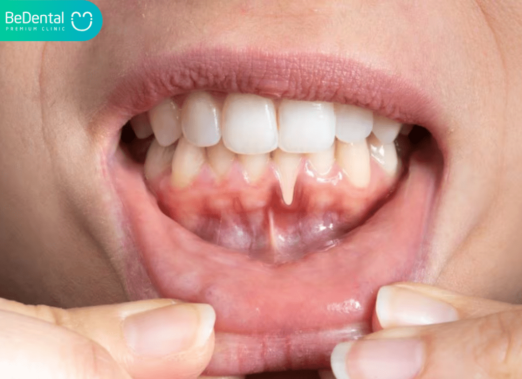 Cách Chữa Viêm Lợi Tại Nhà Nhanh Nhất: Bí Quyết Giảm Đau Và Phục Hồi Hiệu Quả 2 cách chữa viêm lợi tại nhà nhanh nhất