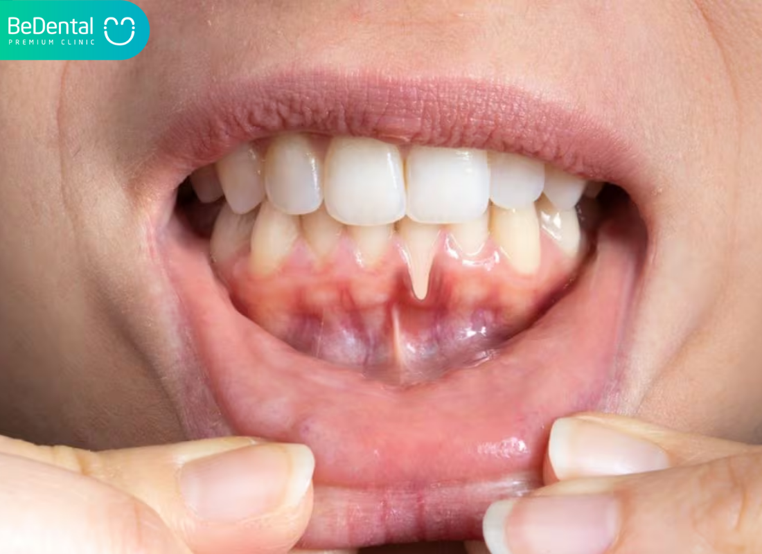 cách chữa viêm lợi tại nhà nhanh nhất