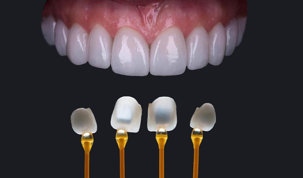 dan su veneer co tot khong