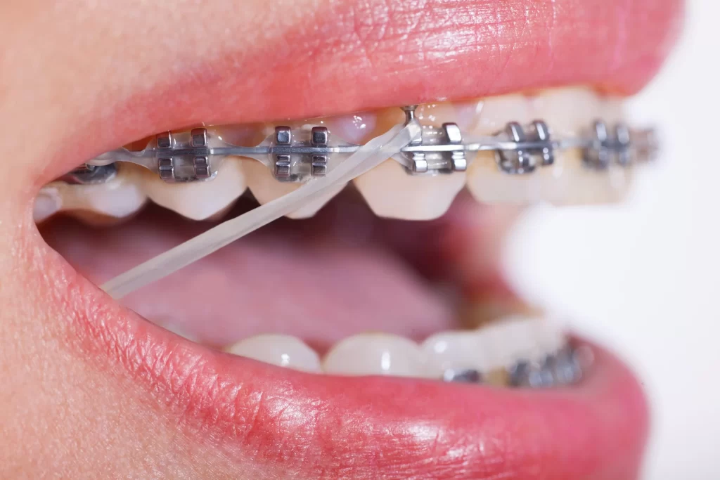 Single Arch Braces in Vietnam. Single Arch Braces in Vietnam. Single Arch Braces in Vietnam