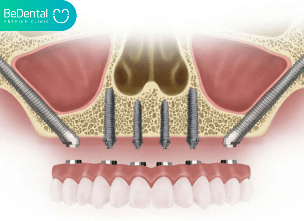 zygoma implant 01