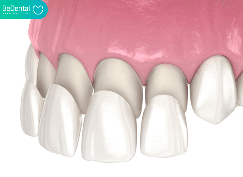 Bọc Răng Composite: Giải Pháp Thẩm Mỹ Nhanh Chóng, An Toàn Và Hiệu Quả 2 bọc răng composite