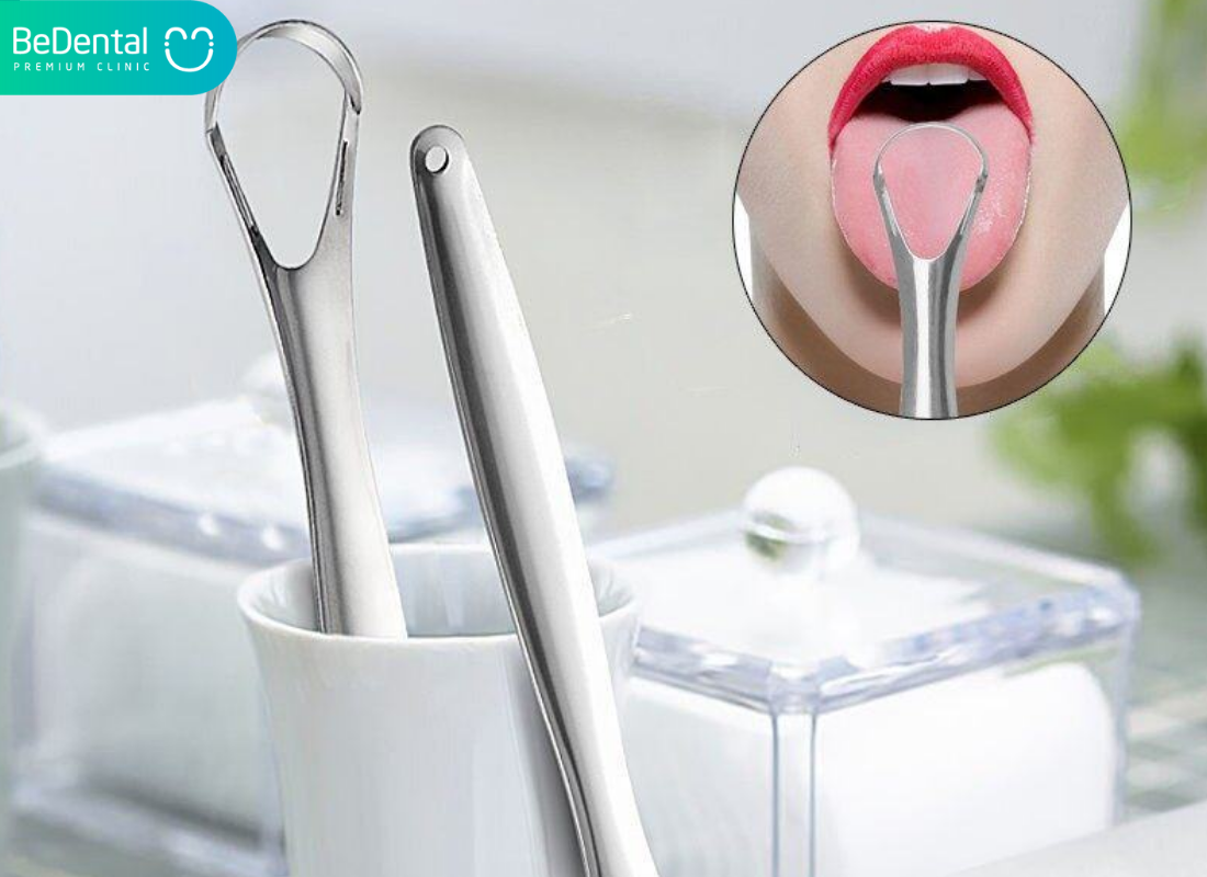 Nấm miệng là gì? Nguyên nhân, triệu chứng và cách điều trị khi bị nhiễm nấm 3 Cao luoi