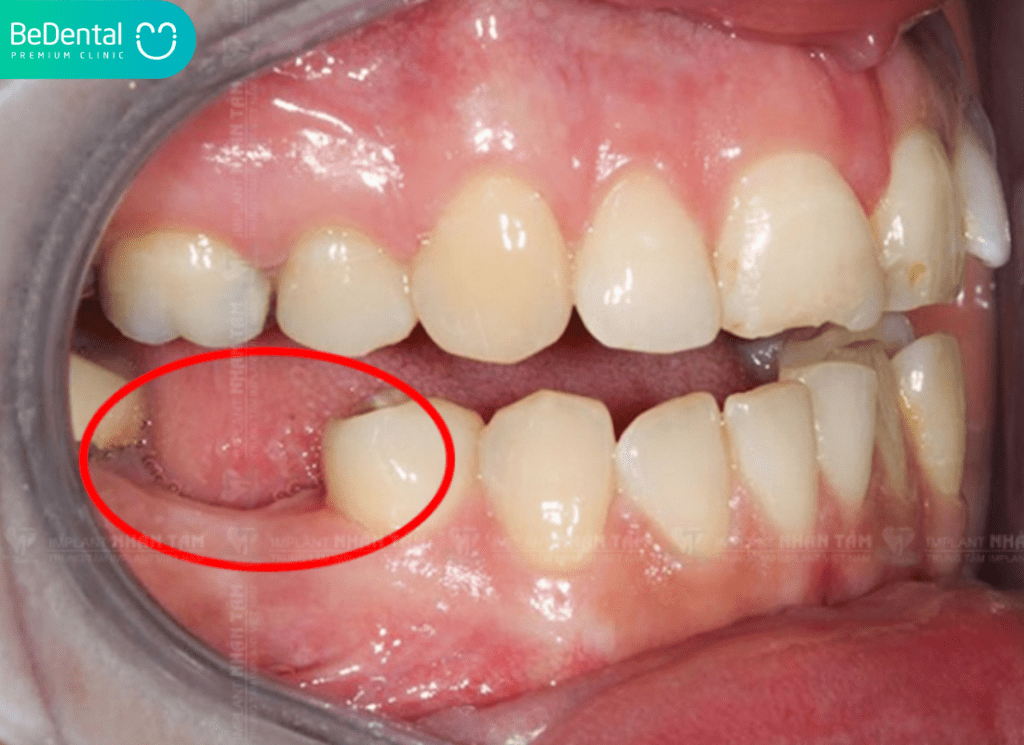 Đau răng số 6 hàm dưới: Nguyên nhân, cách điều trị và phòng ngừa hiệu quả 3 Dau rang so 6 ham duoi