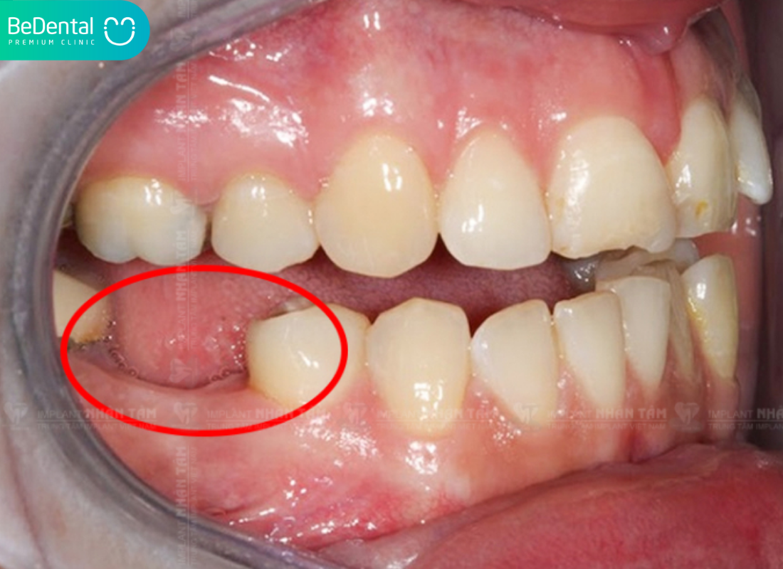 Dau rang so 6 ham duoi