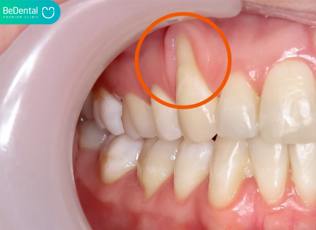 Dieu tri tinh trang tut nuou