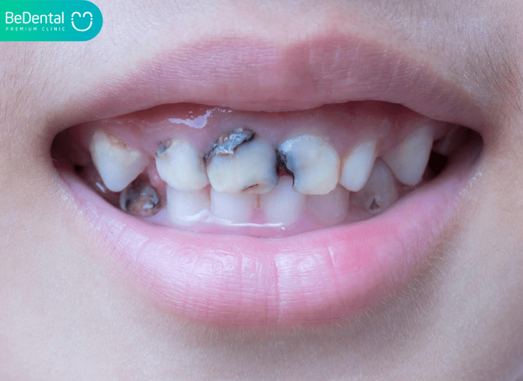 Cách Lấy Mảng Bám Trên Răng Tại Nhà: Hướng Dẫn Chi Tiết Để Răng Trắng Sáng 2 Cách Lấy Mảng Bám Trên Răng Tại Nhà
