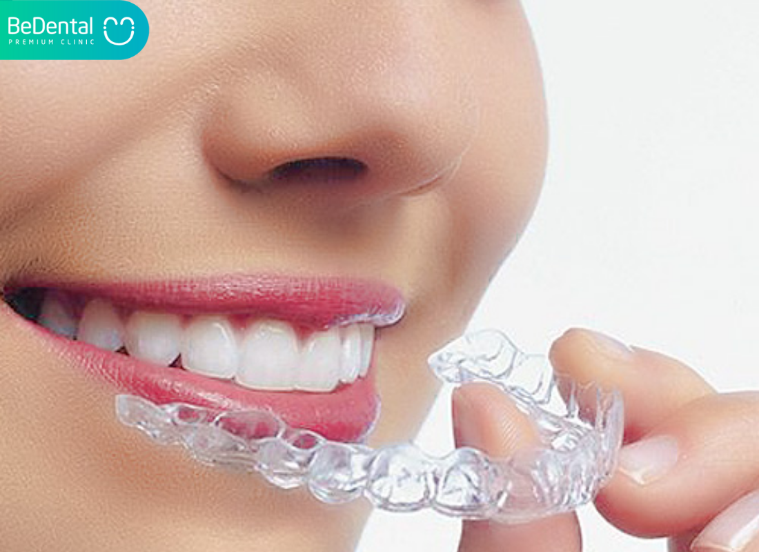 Miếng lót chống nghiến răng