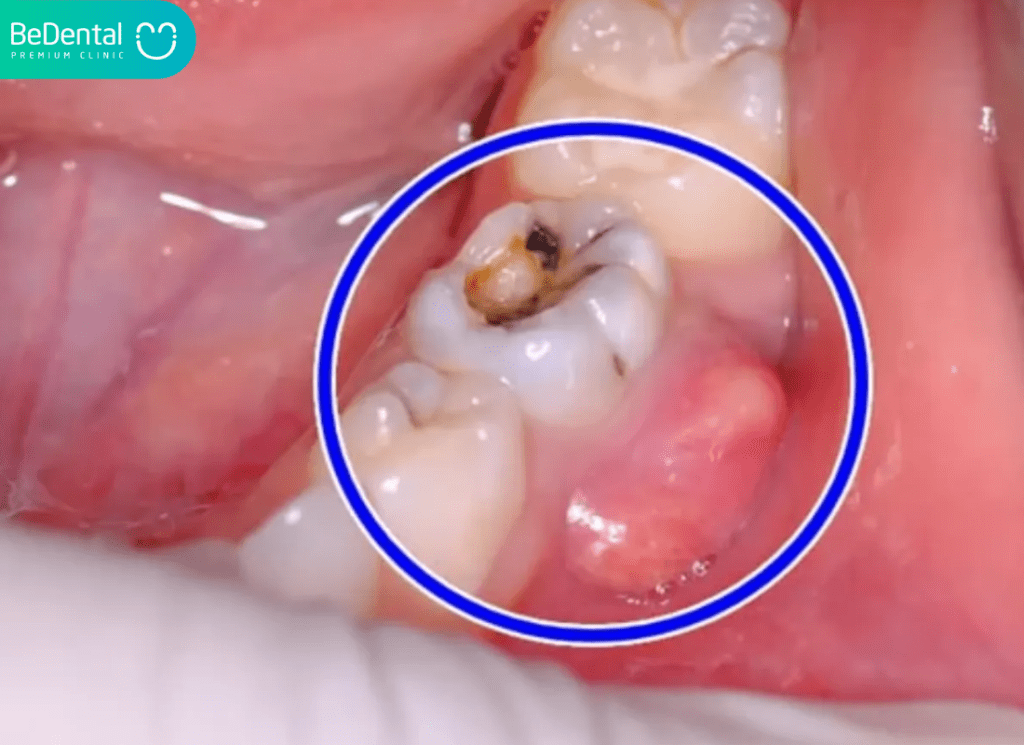 Nhổ Răng Số 8 Nguy Hiểm Không? Cần Lưu Ý Gì Để An Toàn? 3 Nhiem trung rang