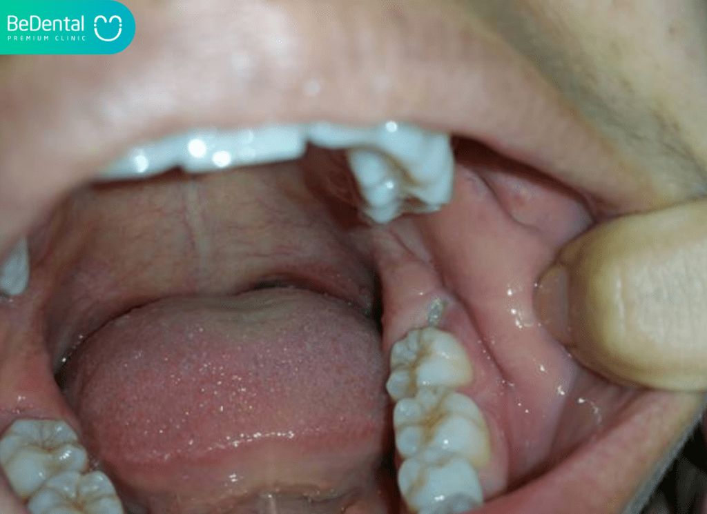 Cách Nhổ Chân Răng: Những Điều Cần Biết Khi Bị Sót Chân Răng Sau Nhổ 3 Nho chan rang con sot