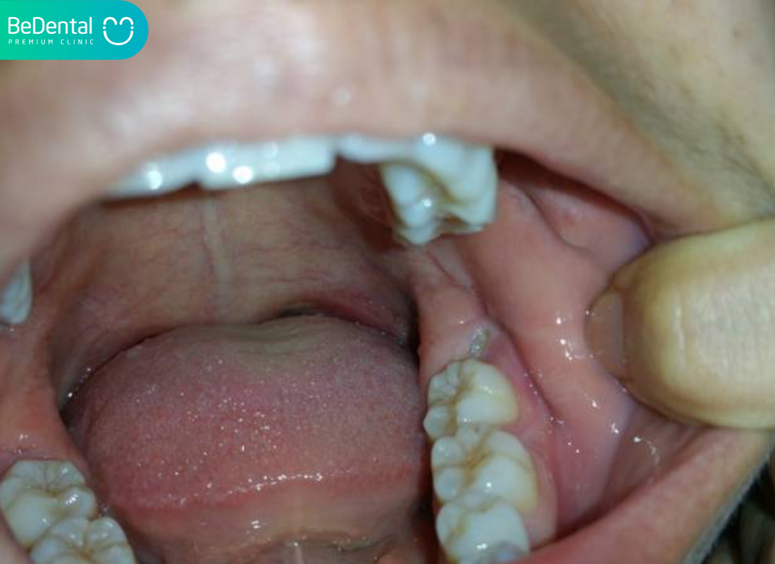 Lỗ hổng sau khi nhổ răng khôn