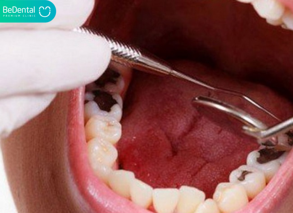 Nhổ Răng Số 8 Nguy Hiểm Không? Cần Lưu Ý Gì Để An Toàn? 2 Nhổ răng số 8 nguy hiểm