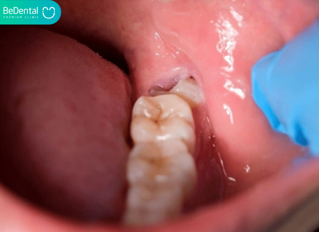 Nhổ Răng Hàm Dưới Có Ảnh Hưởng Gì Không? 3 Nho rang ham duoi co nguy hiem ko02