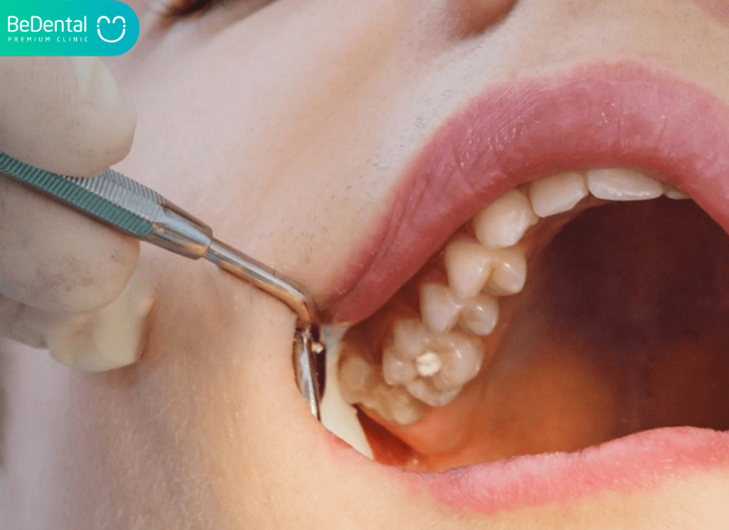 Răng khôn bị sâu vỡ: Nguyên nhân, dấu hiệu và giải pháp xử lý triệt để 5 nên nhổ răng vào lúc nào