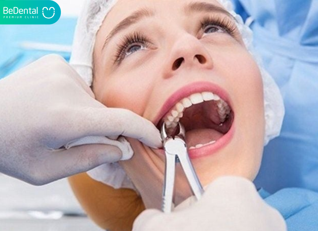 biến chứng sau khi nhổ răng khôn