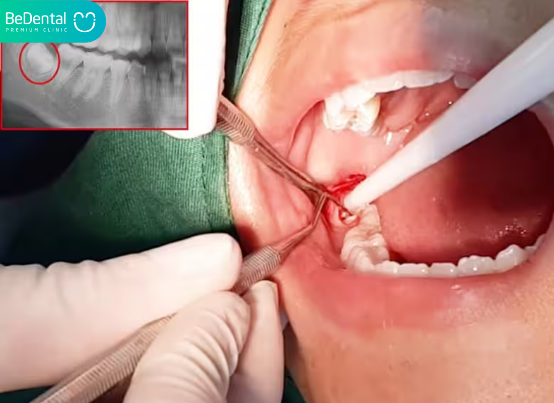 Mọc răng khôn đau mấy ngày? 5 Mọc răng khôn đau mấy ngày?