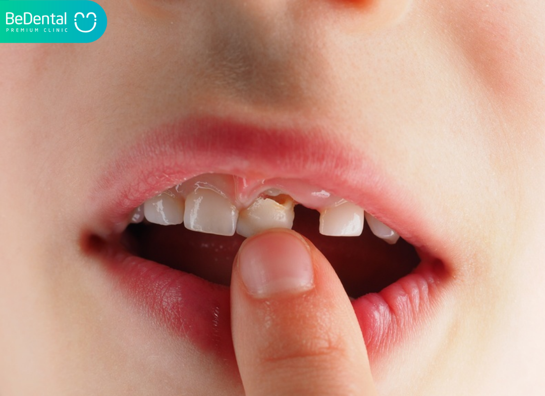 cách nhổ răng tại nhà không đau cho trẻ