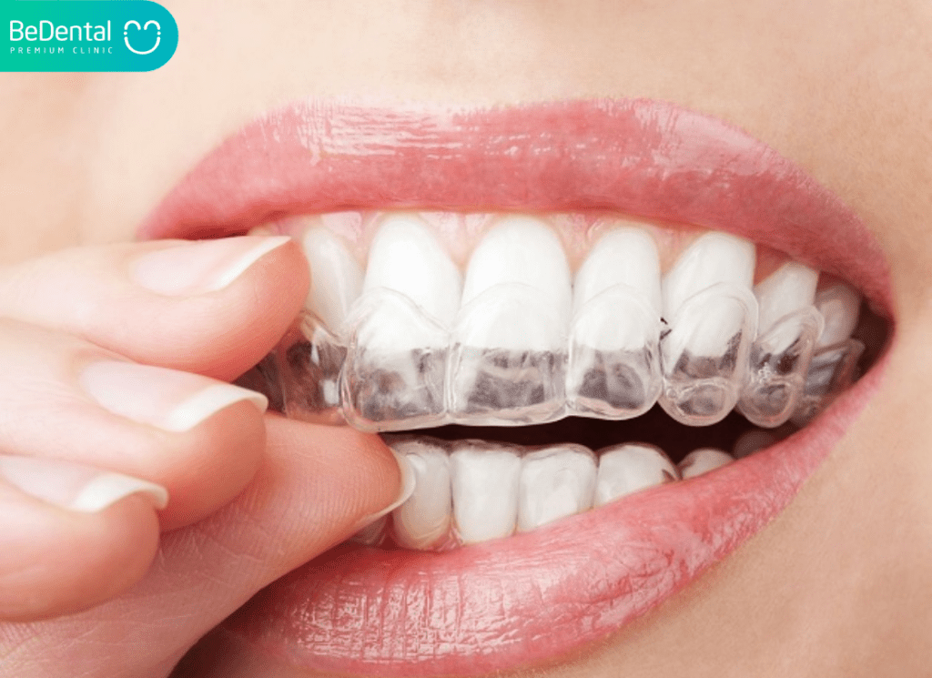 Nieng rang invisalign