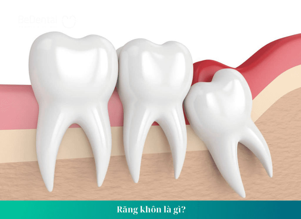 Tại sao phải nhổ răng số 8