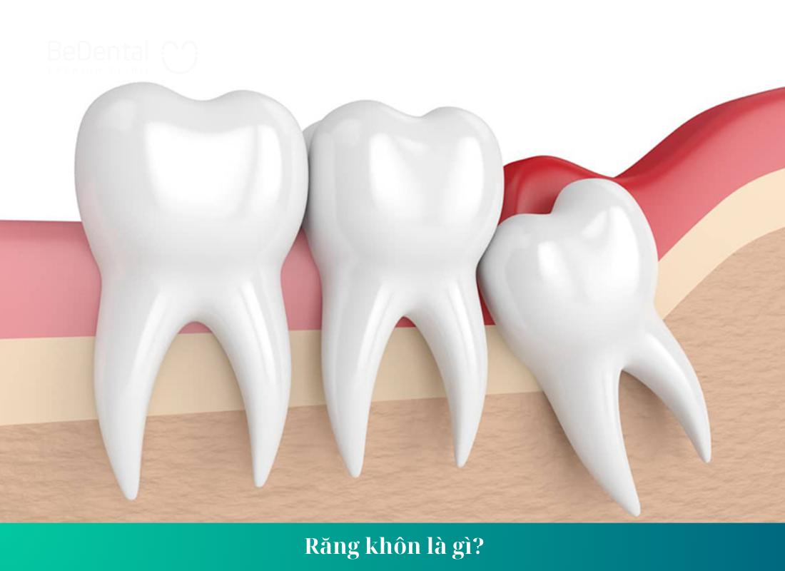 Tại sao phải nhổ răng số 8
