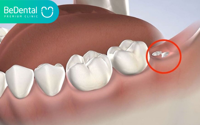 Nhổ chân răng còn sót - Nguyên nhân, Dấu hiệu và Cách khắc phục 2 Nhổ chân răng còn sót