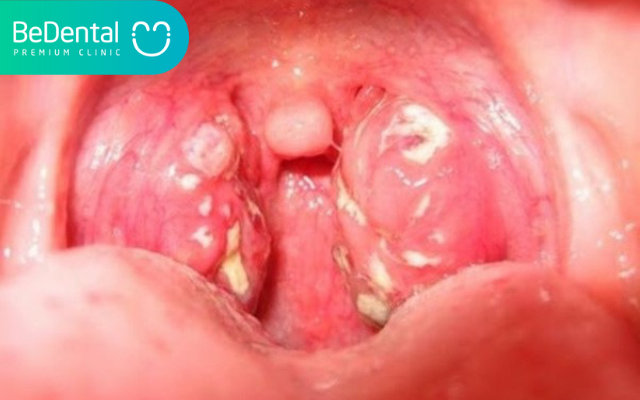 Hình ảnh nổi hạt ở cuống lưỡi